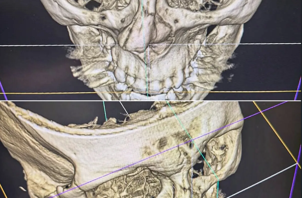 Merab Dvalishvili Refuses Surgery for Broken Nose to Avoid Year-Long Layoff